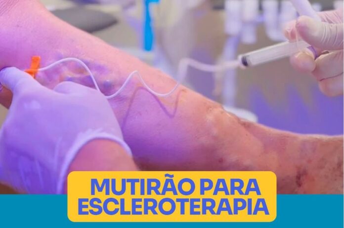 escleroterapia