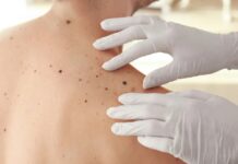 Casos de câncer de pele saltam de 4 mil para mais de 72 mil em 10 anos