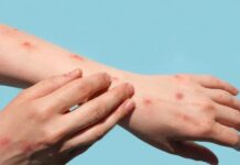 Brasil registra 48 casos de mpox nos primeiros meses de 2026