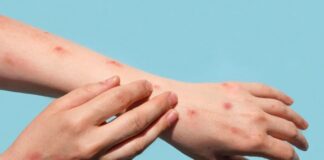 Brasil registra 48 casos de mpox nos primeiros meses de 2026