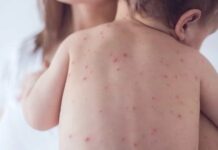 Caso confirmado de sarampo acende alerta sobre cobertura vacinal